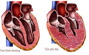 Cơ tim phì đại: Nguyên nhân, triệu chứng và cách điều trị