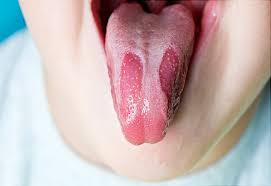 Viêm lưỡi bản đồ: Nguyên nhân, triệu chứng và cách điều trị